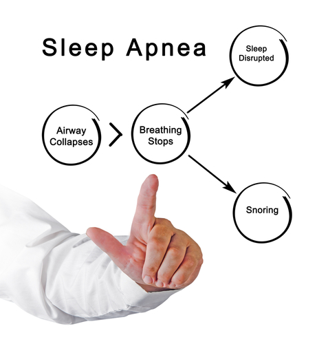 3 Possible Solutions To Sleep Apnea Astoria NY   Leibowitz 3 Solutions Sleep Apnea 