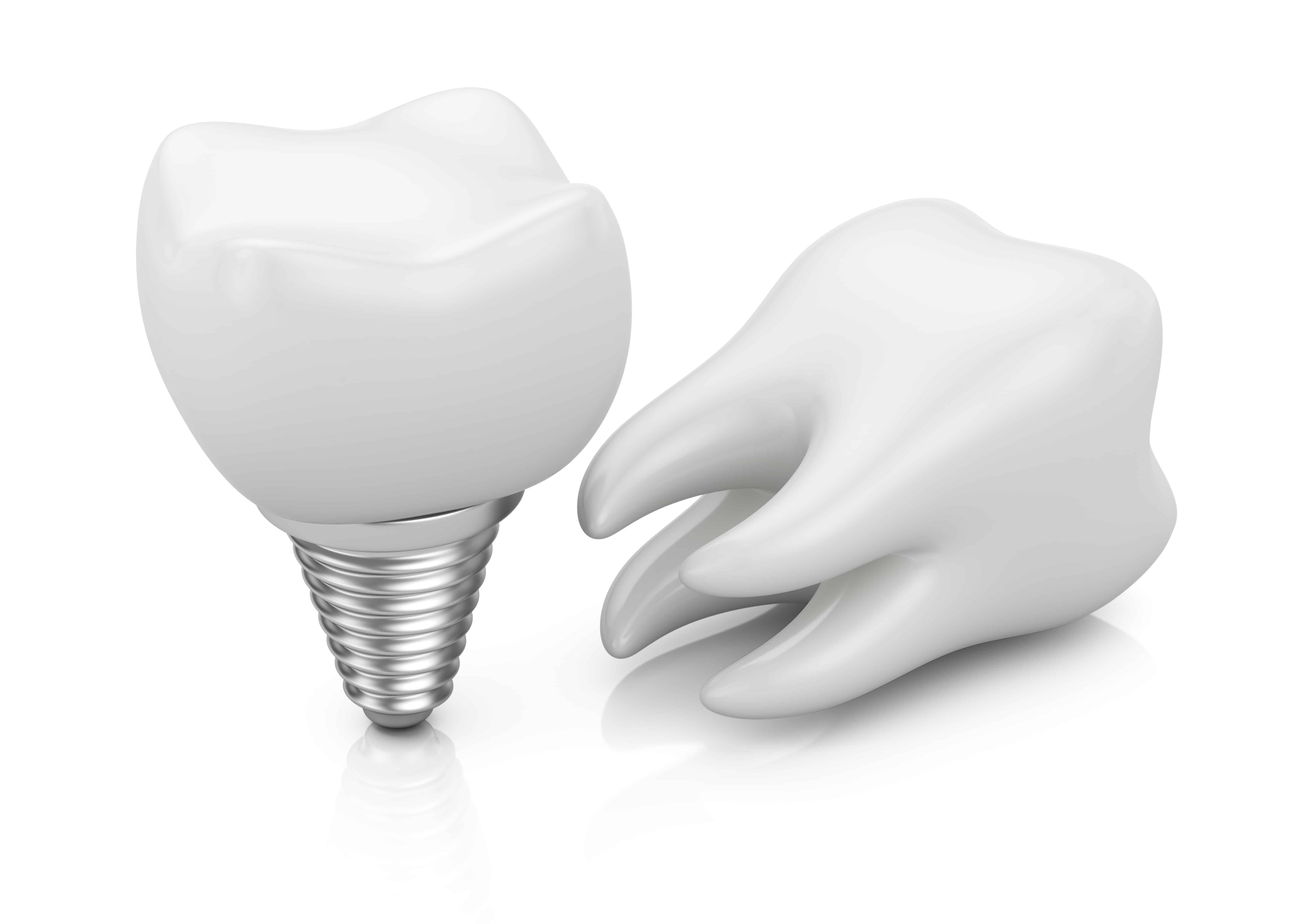 how-are-dental-implants-different-from-bridges-and-dentures-astoria-ny