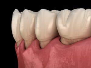 gingivitis and gum disease 