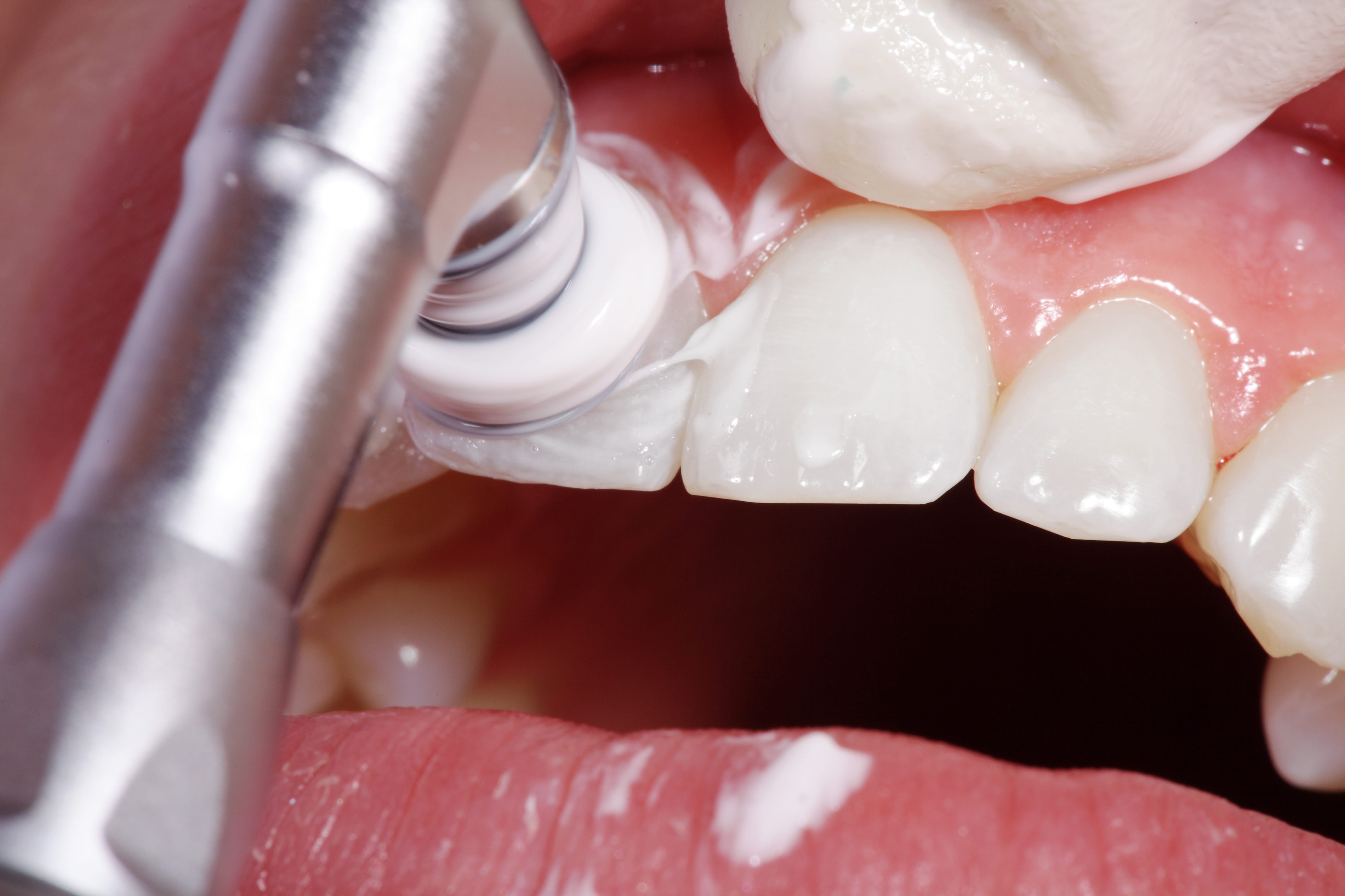 astoria-dentist-discusses-the-dangers-of-plaque-buildup-astoria-ny