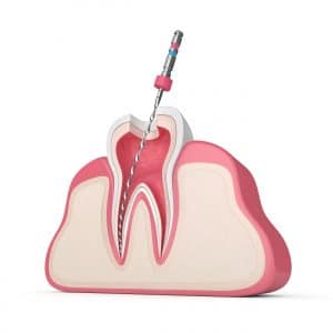 root canal procedure