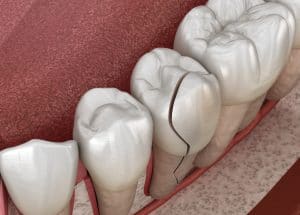 chipped tooth emergency