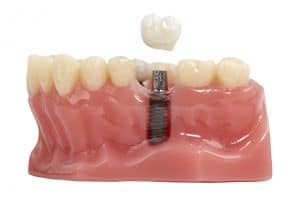 dental implant crown