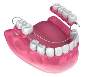 partial denture