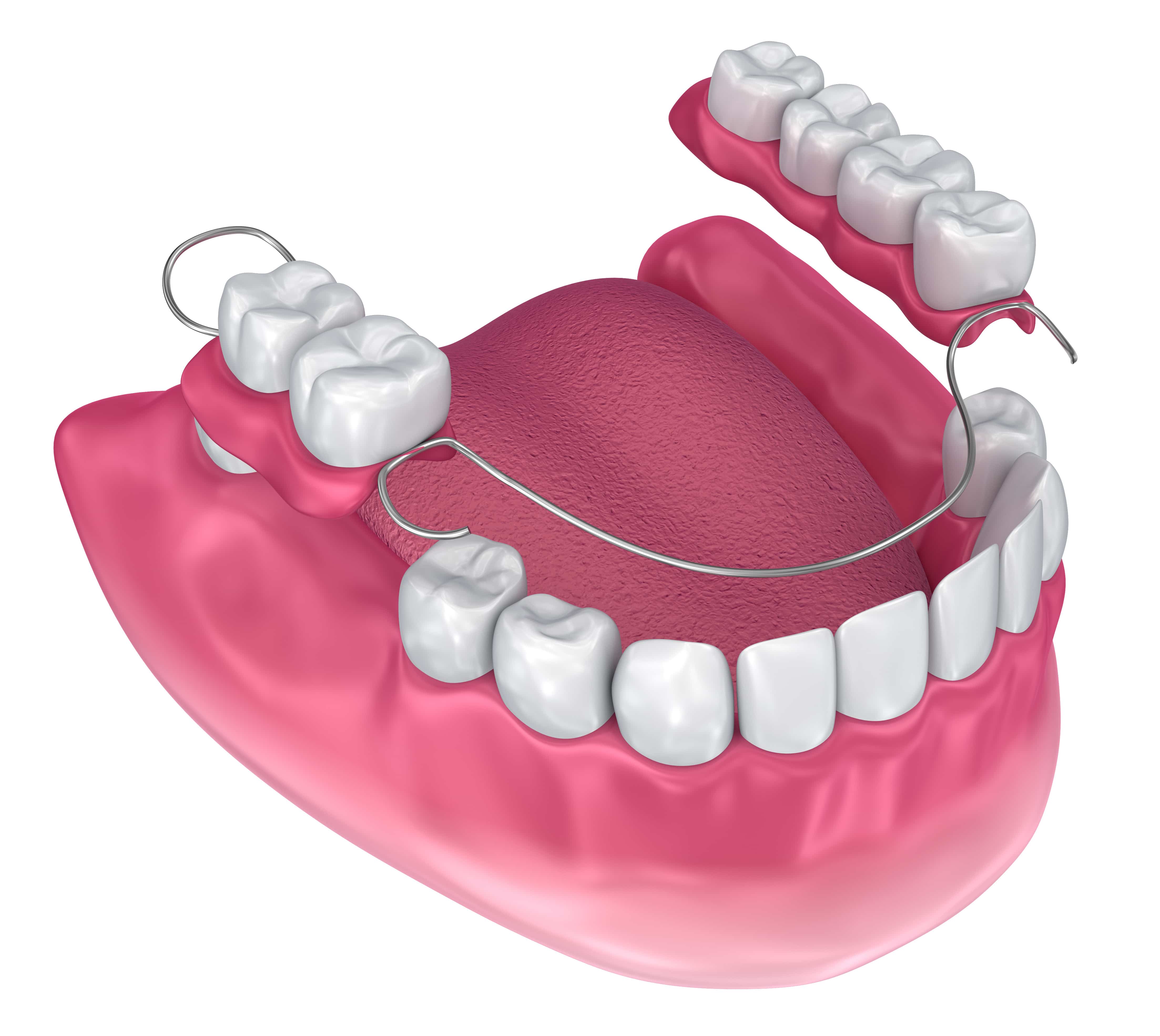 Astoria Dentist Looks At When Your Smile Needs A Partial Astoria Ny 7539