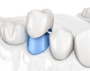 dental crown leibowitz 