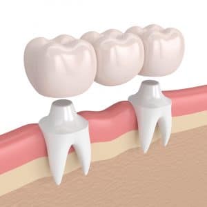 dental bridge