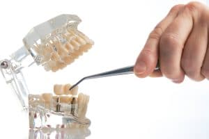 dental implant restoration astoria