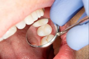 two chewing side teeth of the upper jaw after treatment of caries. Restoration of the chewing surface with a photopolymer filling material using the Rubber Dam system