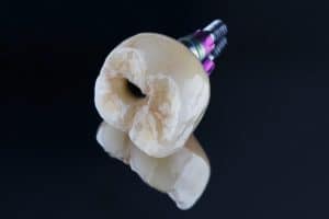 astoria dental implant restoration