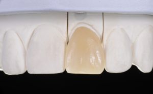 astoria dental veneers