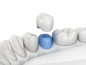 astoria dental crown