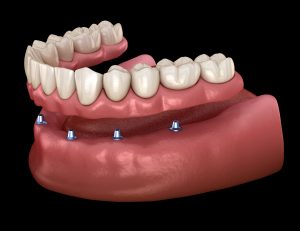 astoria full implant dentures