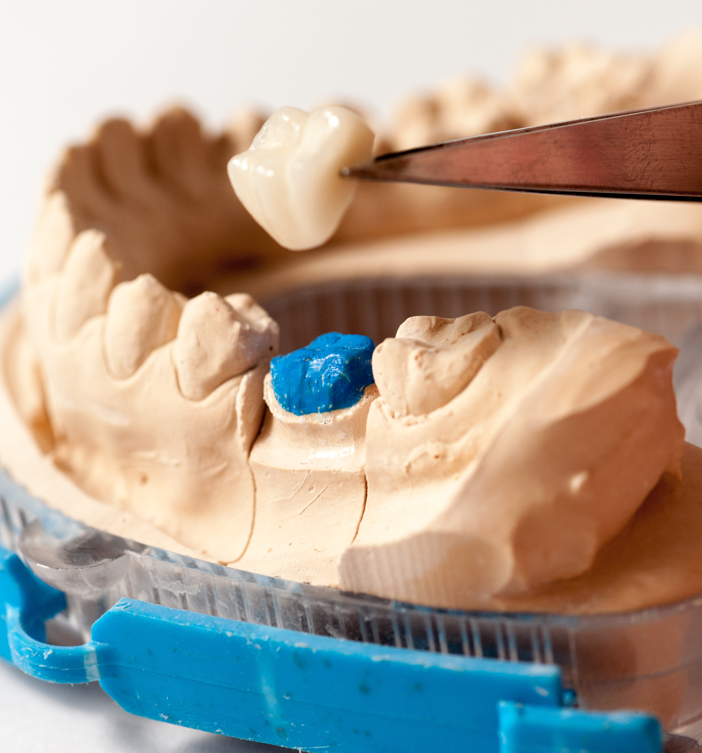 How Do Crowns Restore A Tooth? Astoria, NY