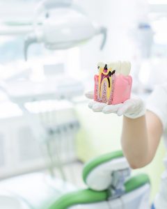 astoria root canal treatment
