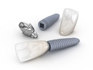 astoria implant restorations