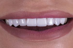 astoria porcelain veneers