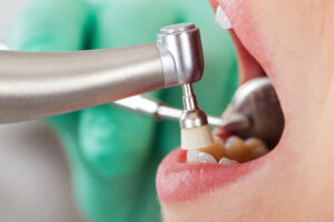 astoria dental cleaning