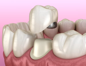 astoria dental crowns