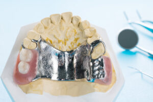 Astoria partial denture