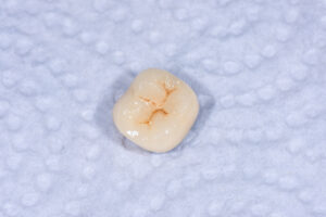 Astoria implant restorations