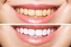 Astoria teeth whitening