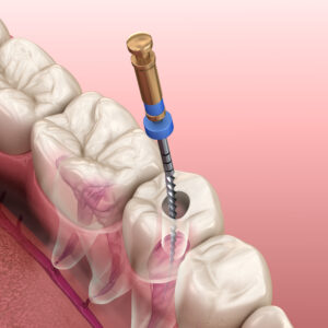 astoria root canal