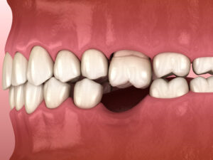 astoria tooth loss