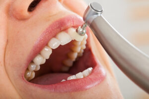 astoria dental cleanings