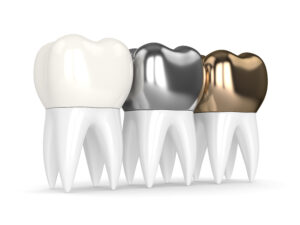 astoria dental crowns