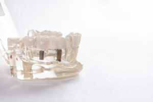 astoria dental implant bridge
