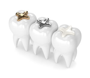 astoria dental fillings