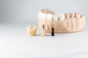 astoria dental implants