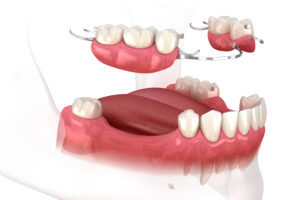 astoria placing partial dentures