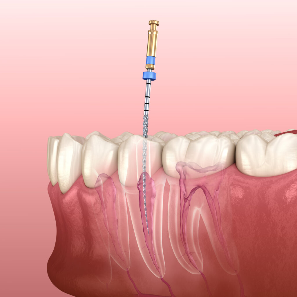 Gentle Treatment With Root Canal Therapy Astoria Ny