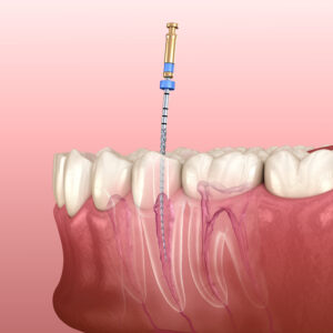 astoria root canal