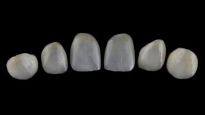 astoria porcelain veneers