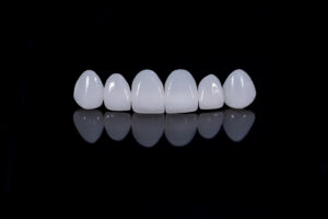 astoria porcelain veneers