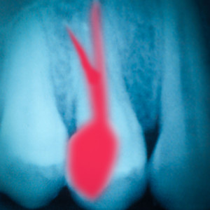 root canal