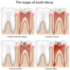 toothdecay