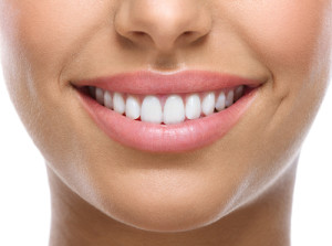 veneers